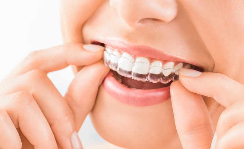 Le traitement Invisalign pour vous redonner le sourire